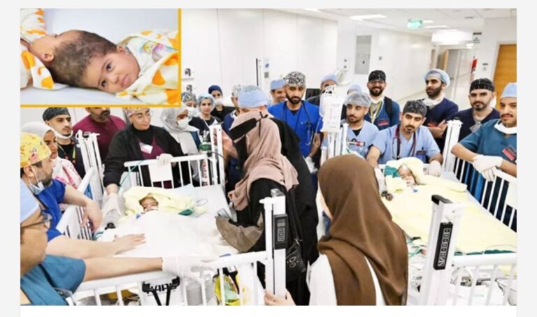 സയാമീസ് ഇരട്ടകളുടെ വേർപെടുത്തൽ ശസ്ത്രക്രീയ വിജയകരം; പതിനഞ്ചര മണിക്കൂർ നീണ്ടുനിന്ന അതിസൂക്ഷ്മ ശസ്ത്രക്രിയയിലൂടെ ഇനി അസ്മയ്ക്കും സുമയ്യയ്ക്കും രണ്ട് ജീവിതം