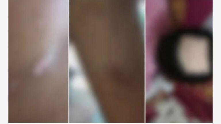 പെരിന്തൽമണ്ണയിൽ ഓട്ടിസം ബാധിച്ച ആറ് വയസുകാരനെ ക്രൂരമായി മർദിച്ച കേസ്; രണ്ടാനമ്മയായ അധ്യാപികയ്ക്കെതിരെ നടപടിയെടുക്കാനൊരുങ്ങി വിദ്യാഭ്യാസവകുപ്പ്