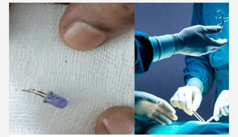 മൂന്നുവയസ്സുകാരന്റെ ശ്വാസനാളത്തിൽ കുടുങ്ങി റിമോട്ട് ബൾബ്; ശസ്ത്രക്രിയയിലൂടെ വിജയകരമായി നീക്കം ചെയ്തു